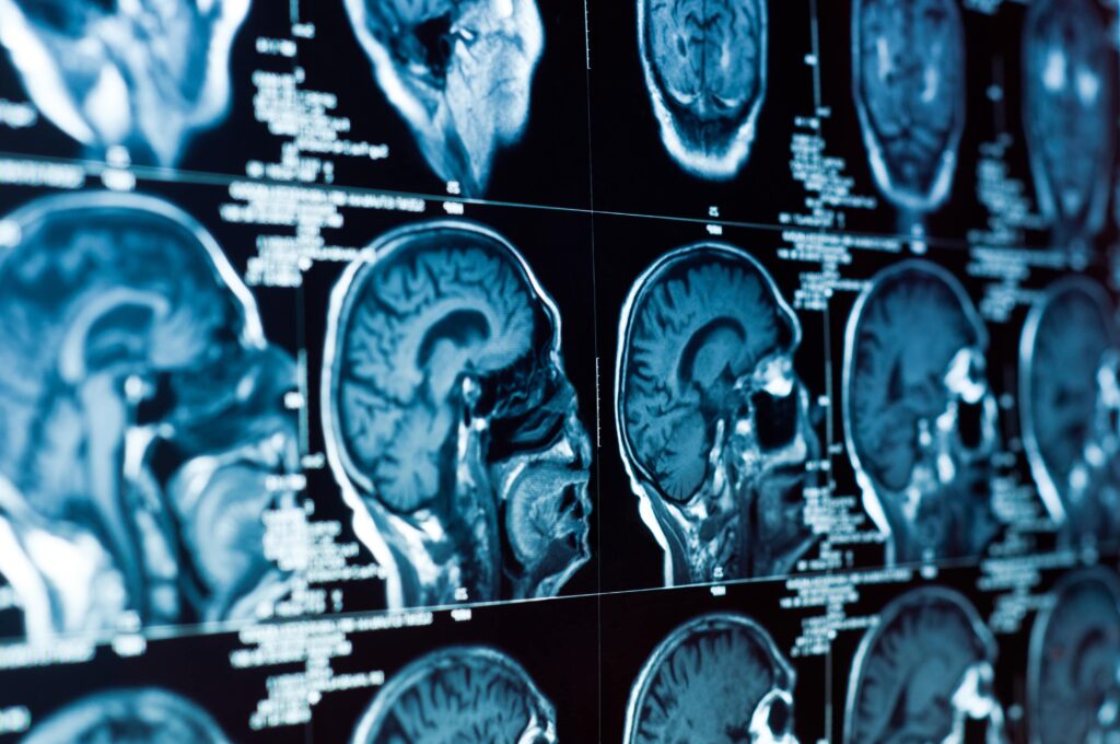 How A Brain Injury Lawyer Can Help You Heal